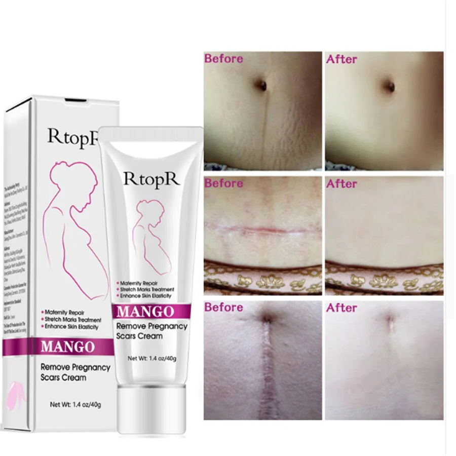 Mango Antenatal Cream - RtopR Body Cream